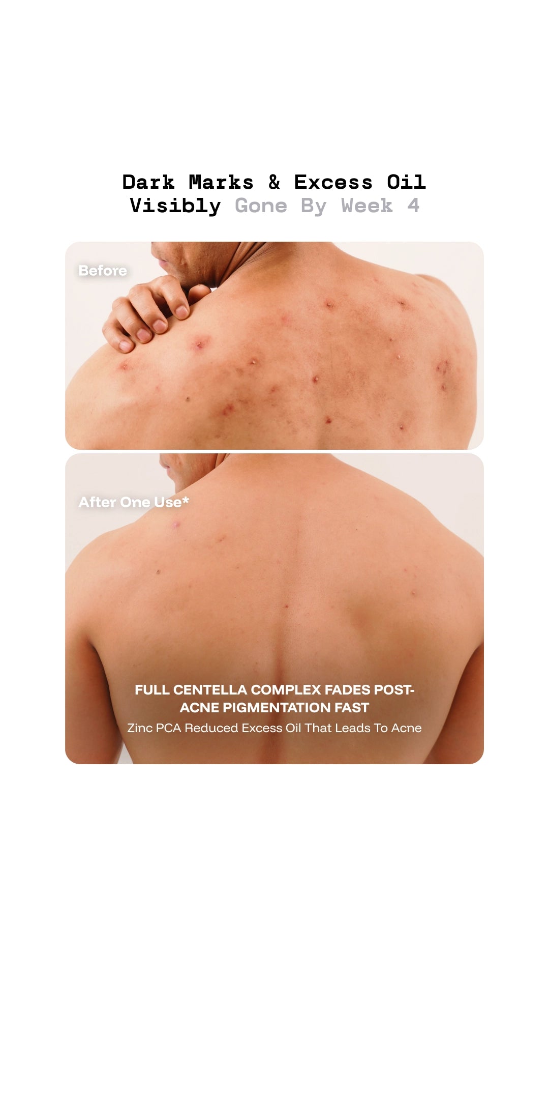 Before and after comparison of dark marks and excess oil on a person's back, with text indicating product effectiveness.