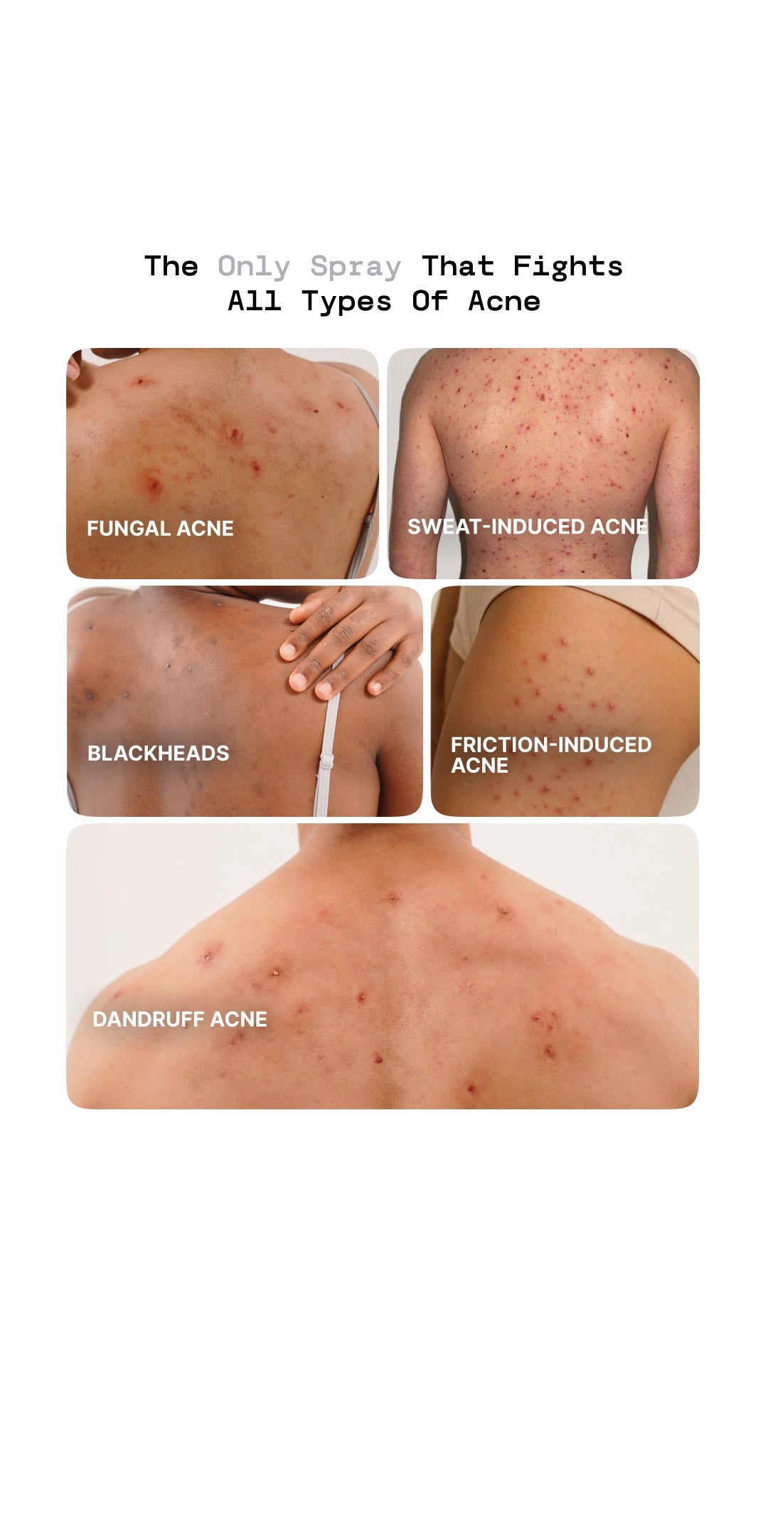 Advertisement for a spray that fights various types of acne on a white background.